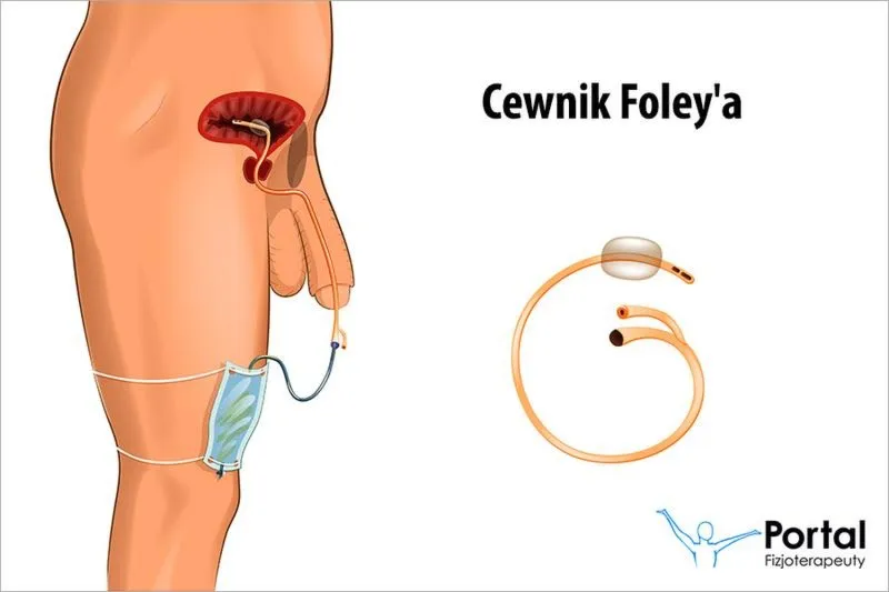 Cewnik dj objawy: kiedy zwrócić uwagę i jak reagować